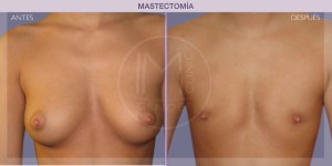 Before and after pictures of mastectomy treatment